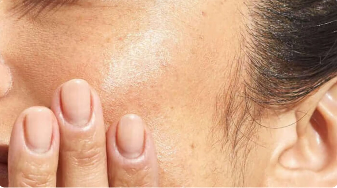 המדע מאחורי כוויות שמש